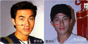 整容部位五，嘴唇 (缩唇，改变唇形)
