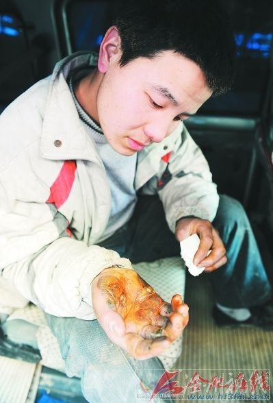 ○为救孩子，伍刚的手被烫得血肉模糊。